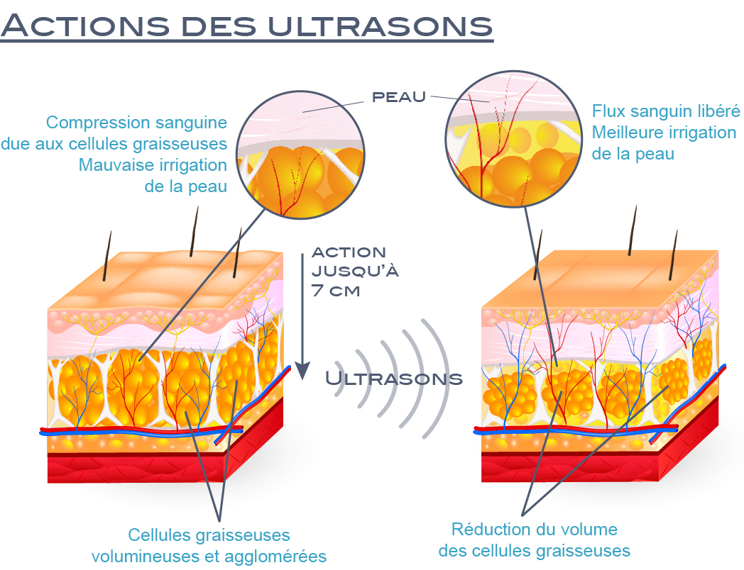 Effets des ultrasons anti cellulite et contre la masse graisseuse