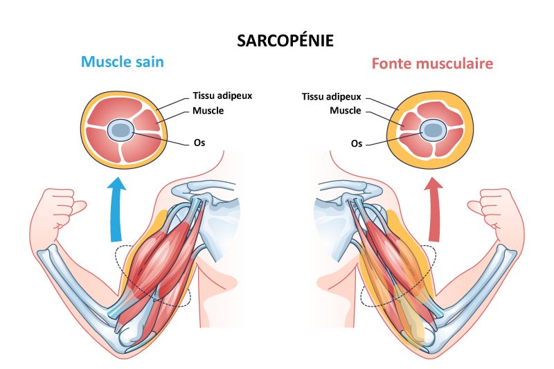 éviter la fonte musculaire et le risque de sarcopénie
